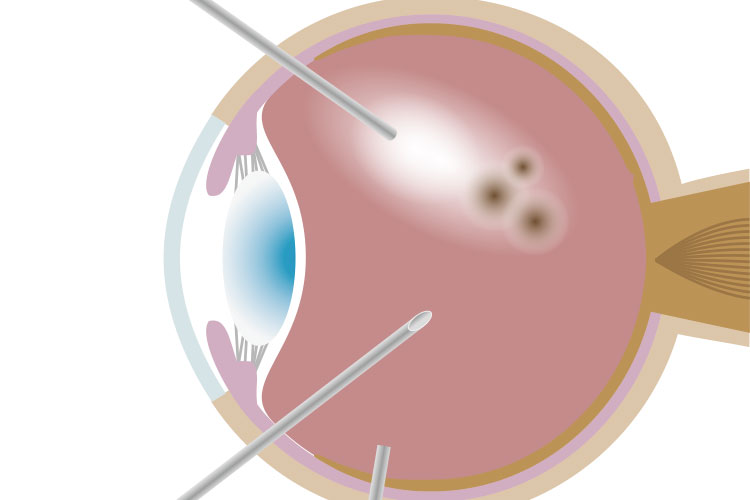 硝子体手術について